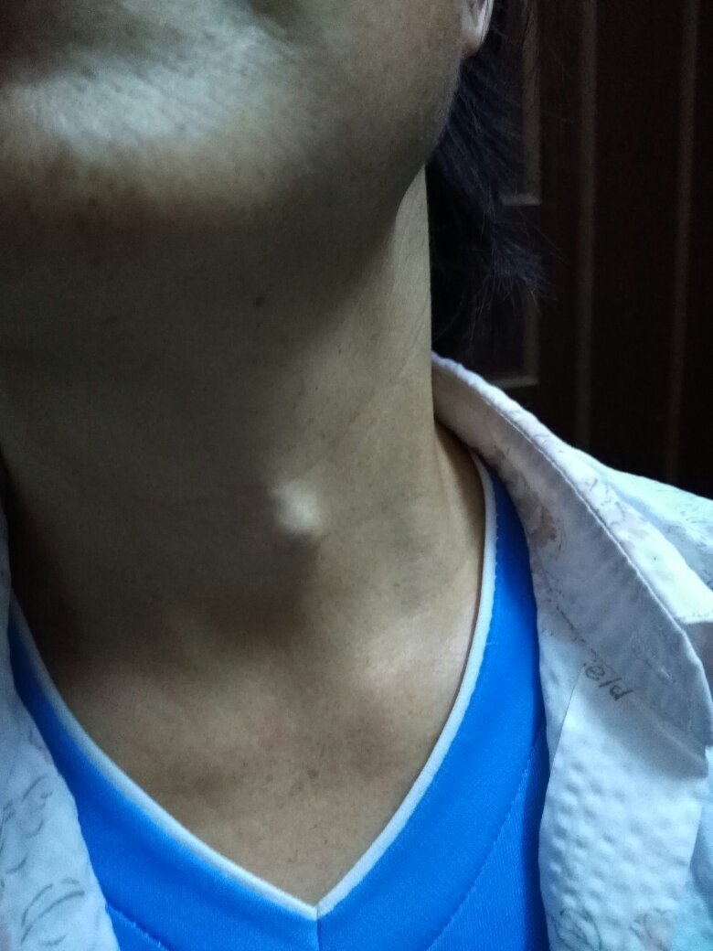 脖子左侧里面有个疙瘩