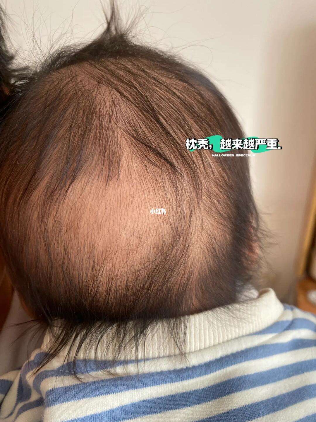 婴儿枕秃是缺钙吗
