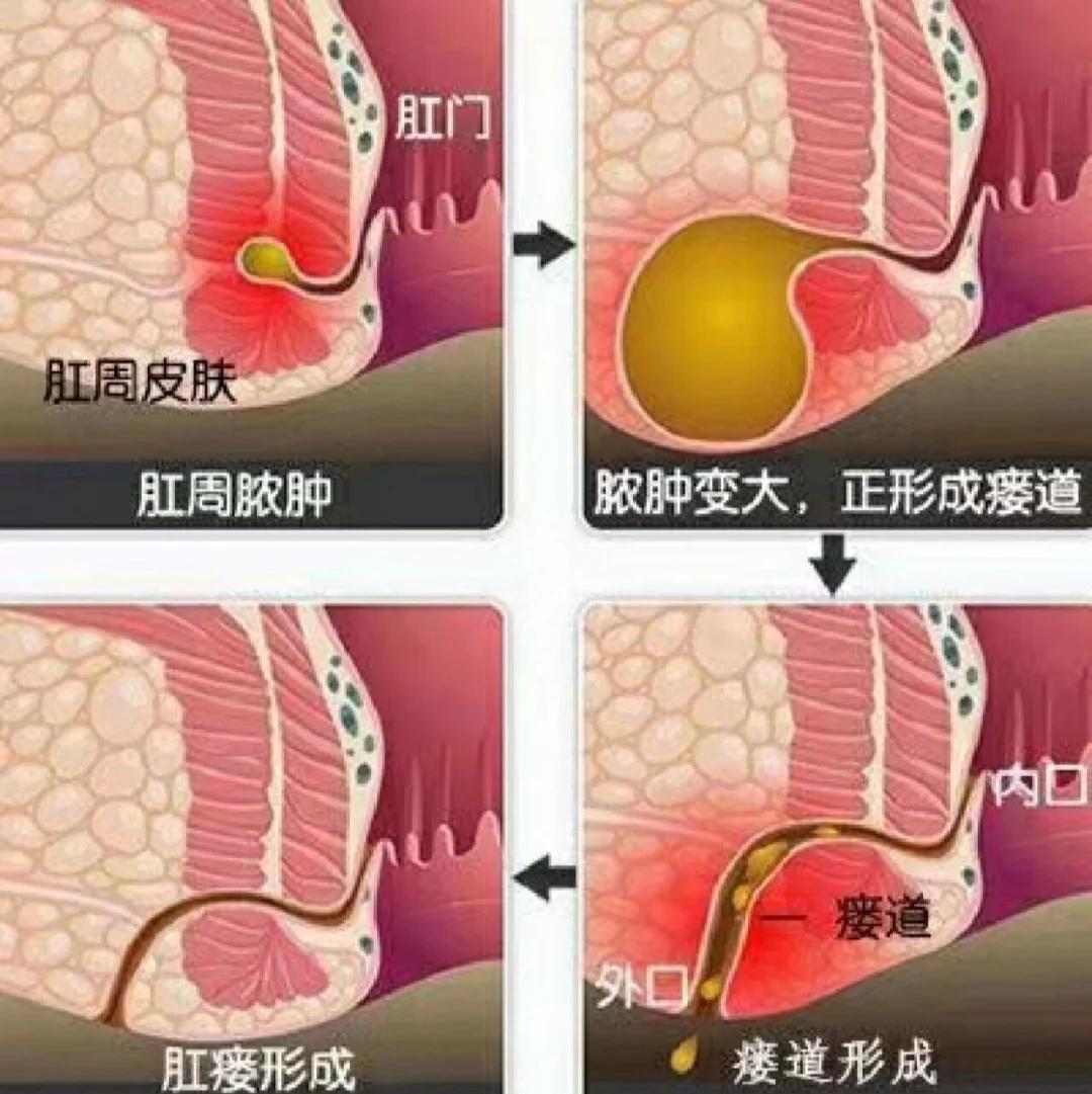 今天上厕所时发现肛门菊花上长了和柔软的小