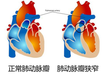 肺动脉瓣狭窄的表现