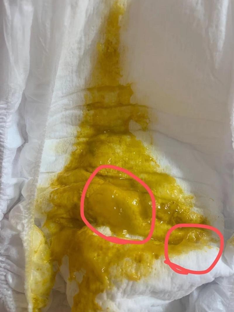 大便带脓,是什么病?