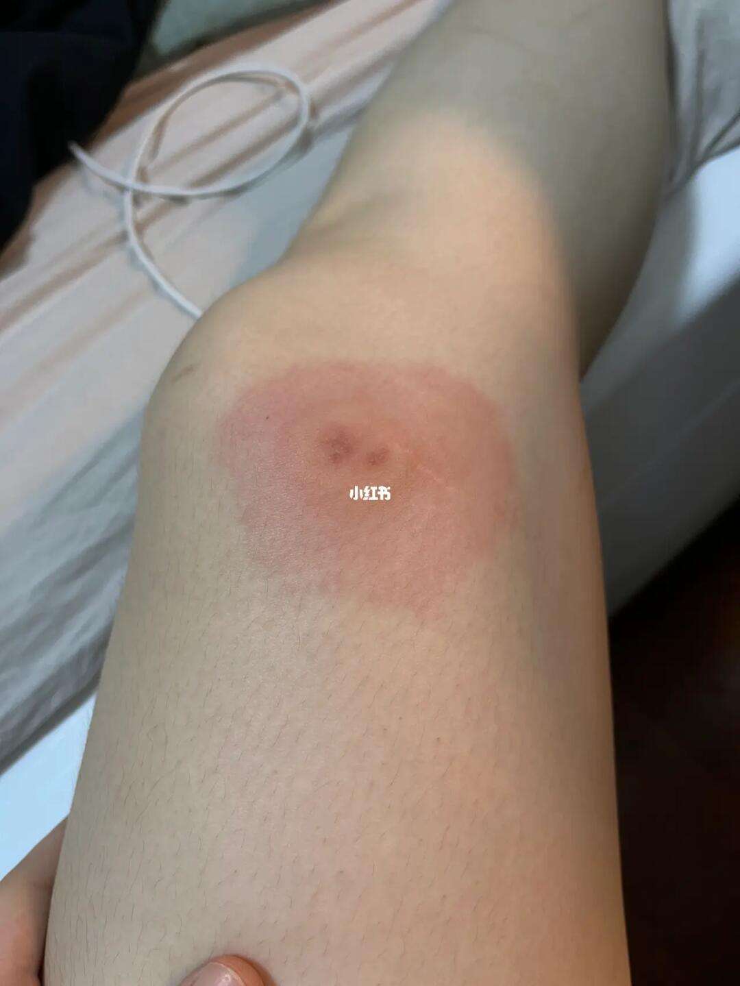 虫咬皮炎能自愈吗