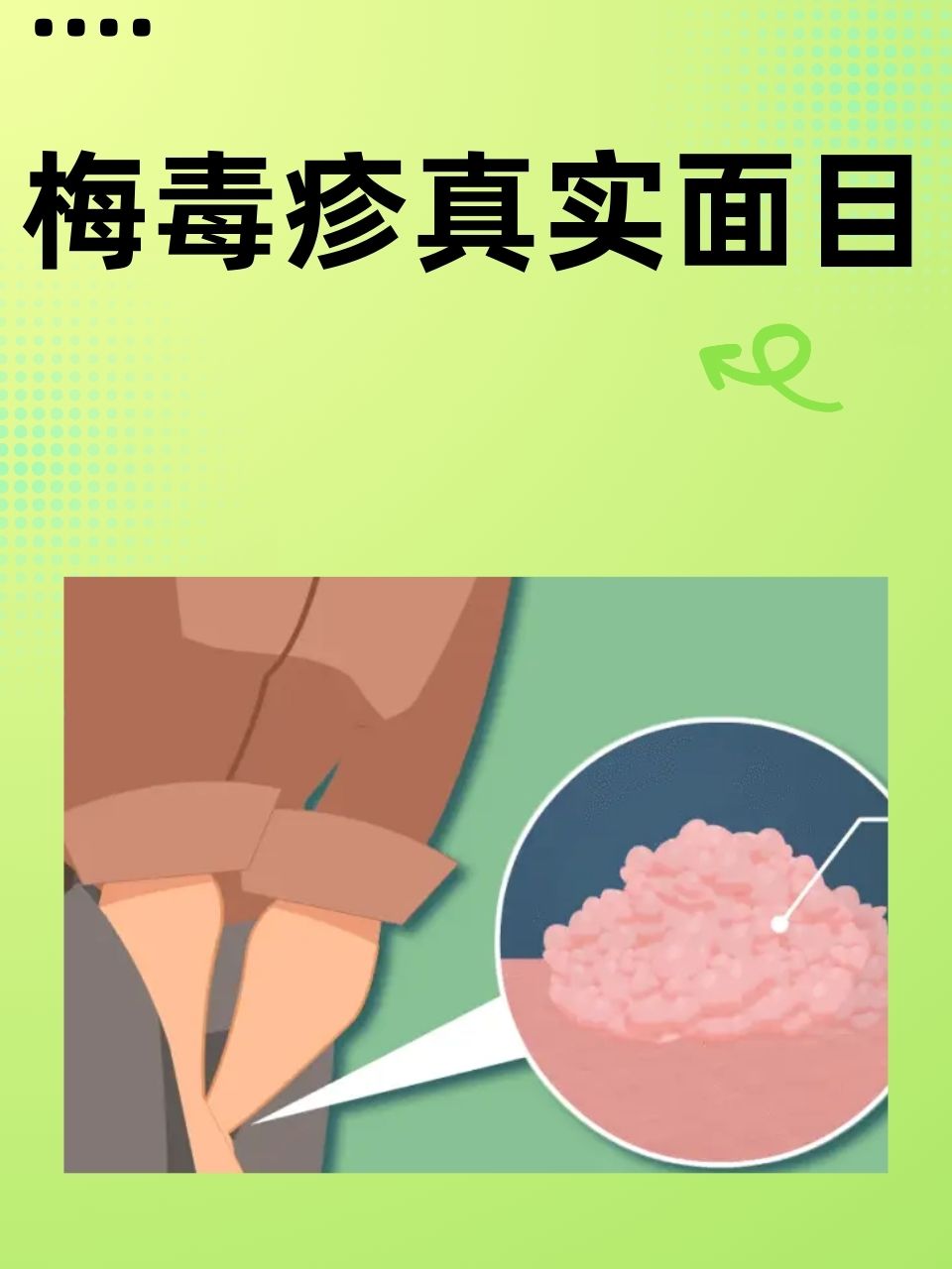 女性梅毒是什么原因引起的
