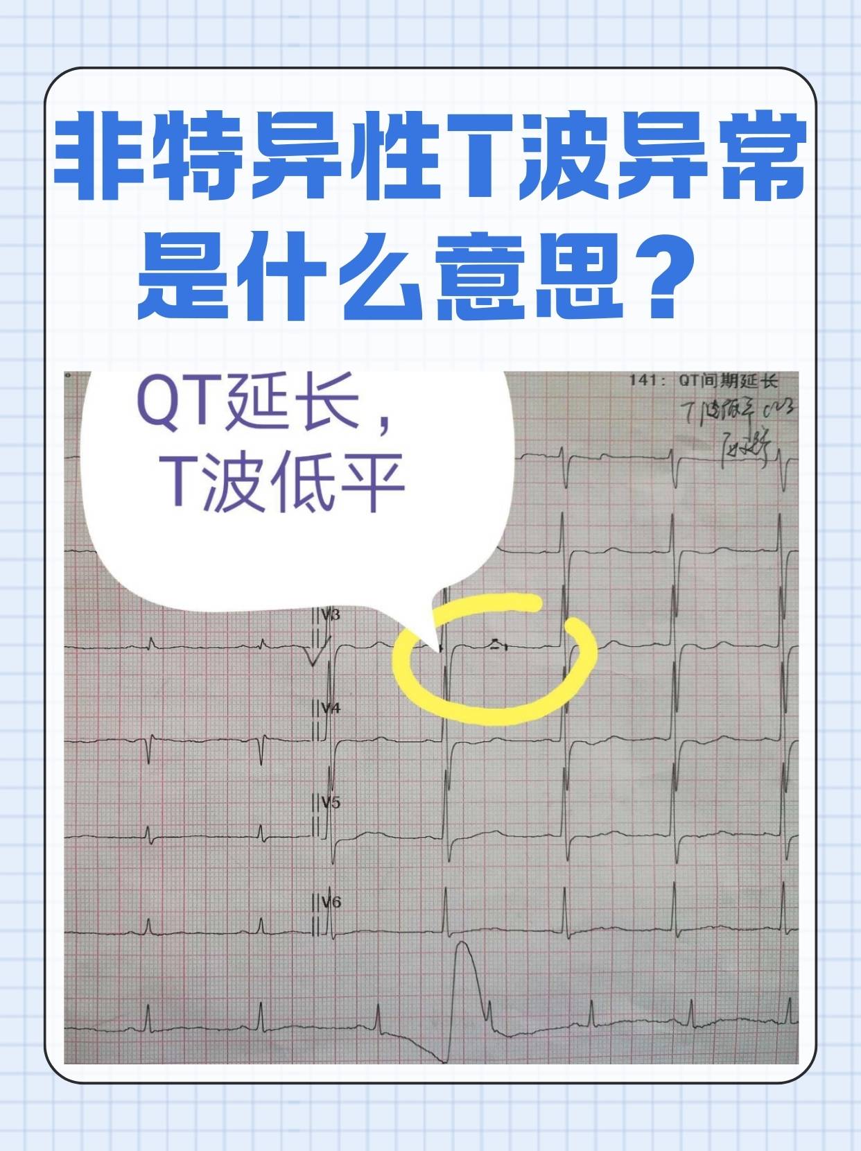窦性心律t波异常是什么意思