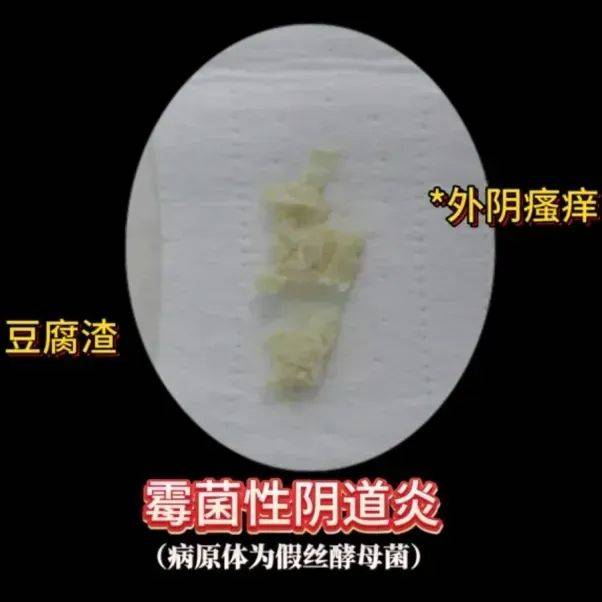细菌性阴道炎的原因