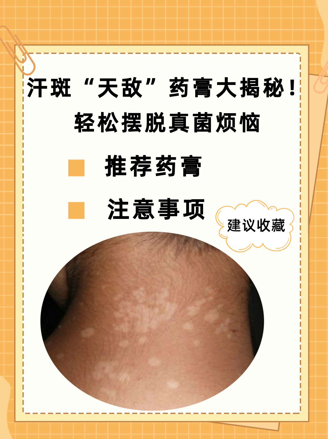 花斑癣能治好吗