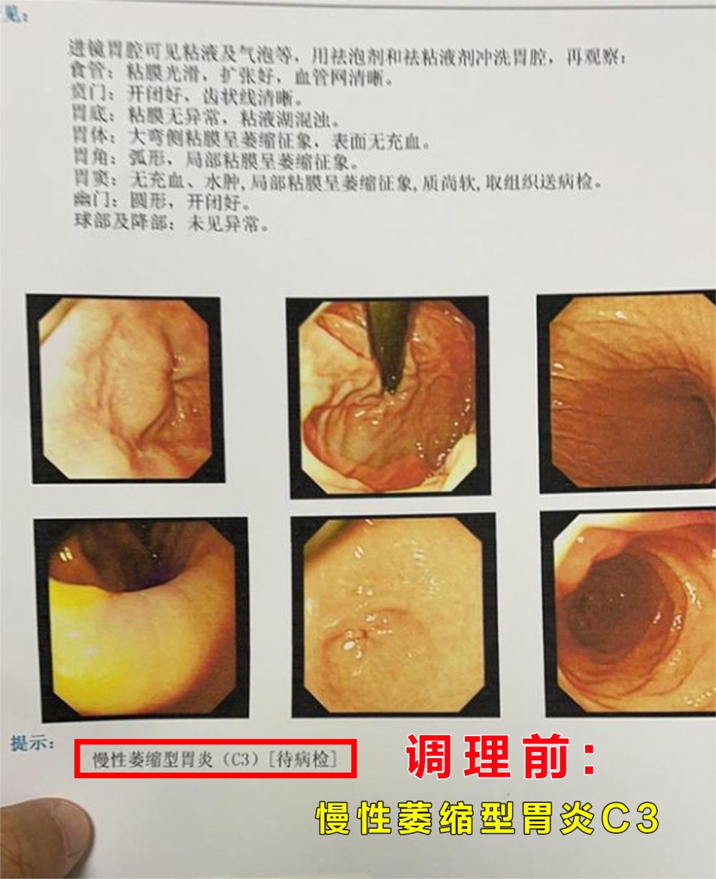 慢性萎缩性胃炎伴糜烂严重吗