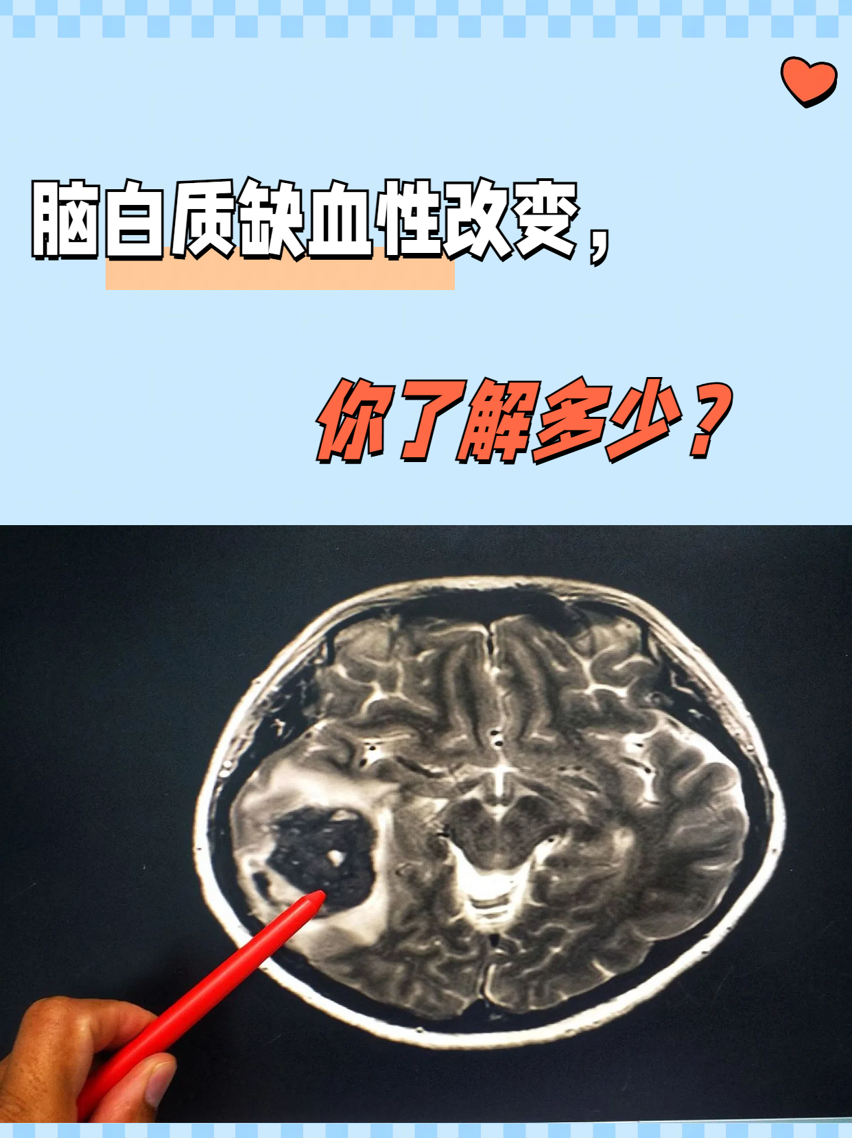 老年性脑改变是怎么回事