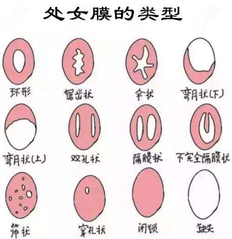 处女膜长什么样