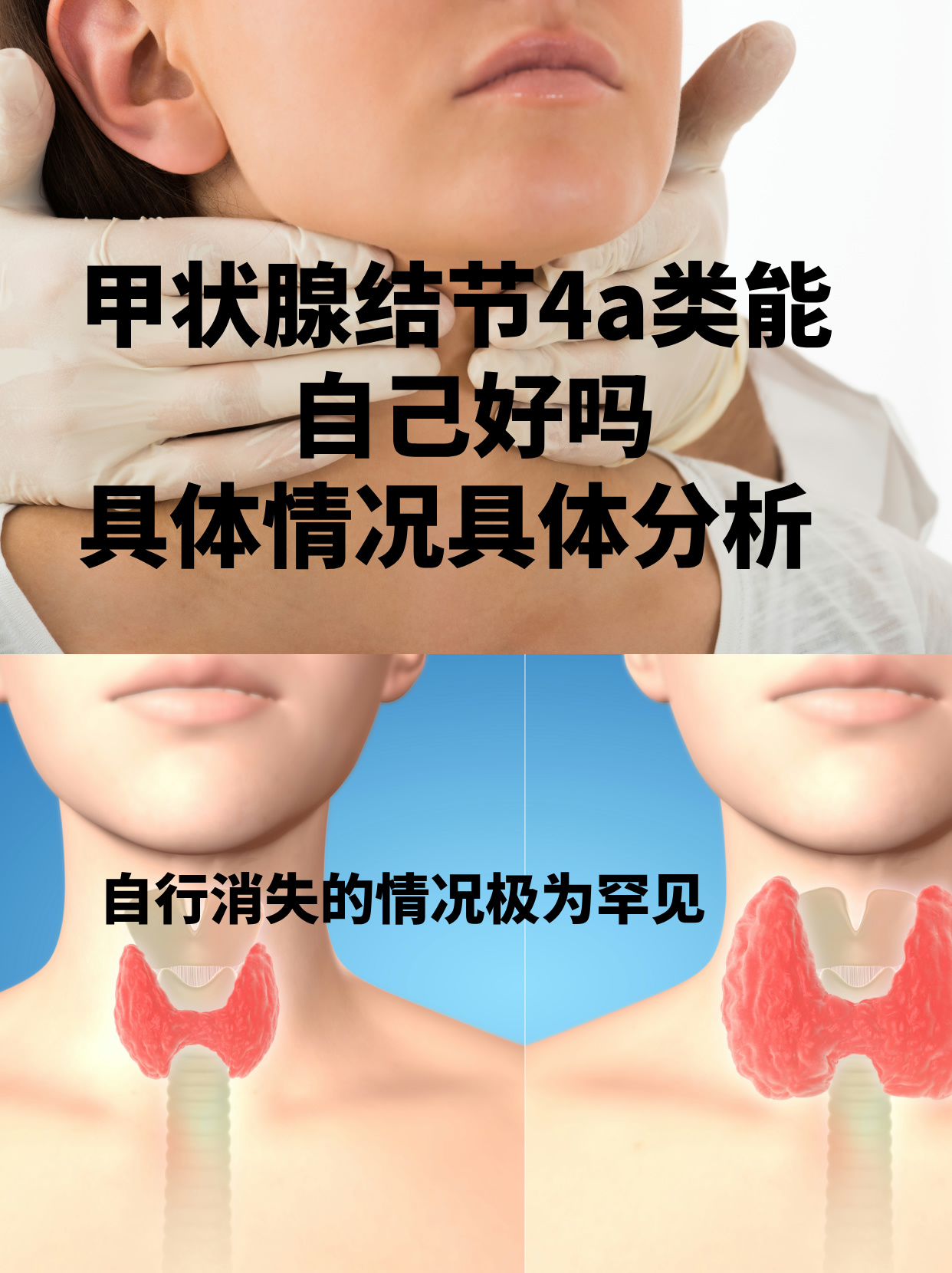 甲状腺ca什么意思