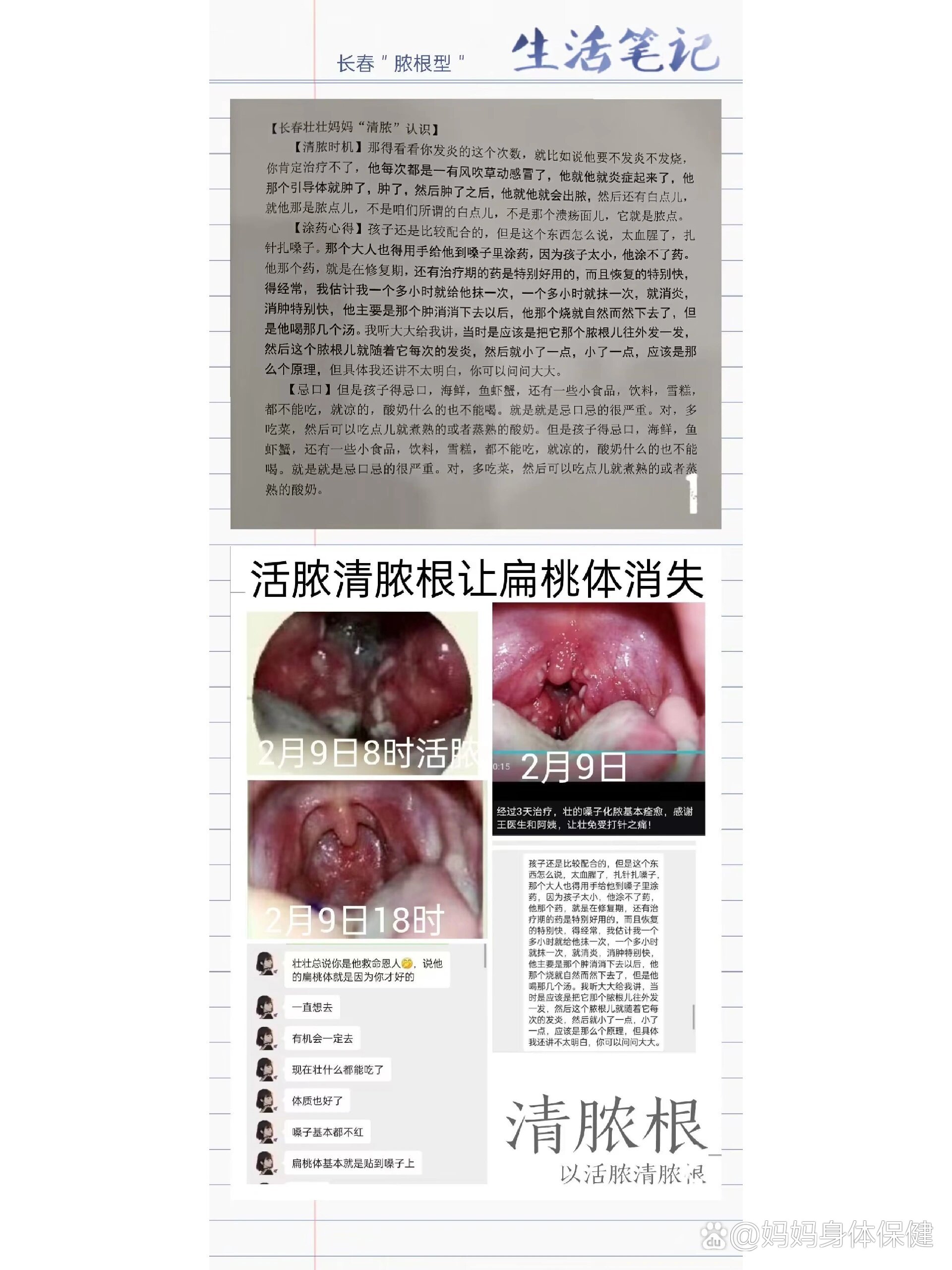 急性化脓性扁桃体炎多久好