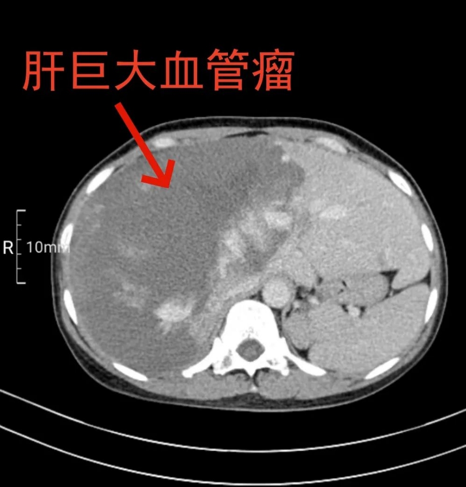 肝血管瘤危险吗