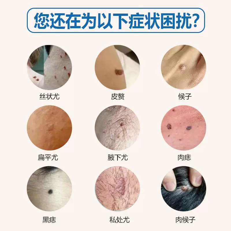 氟尿嘧啶软膏治疗扁平疣