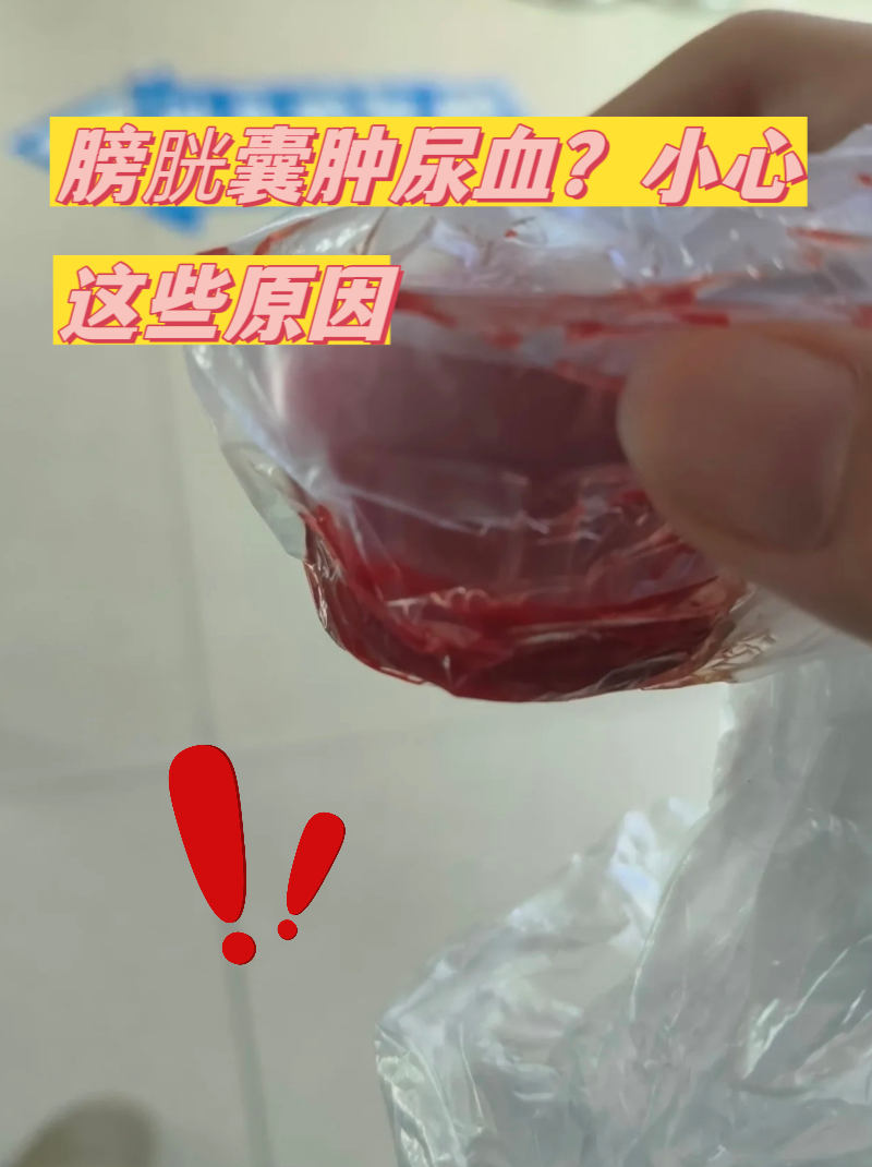 请问医生这个是血尿吗?
