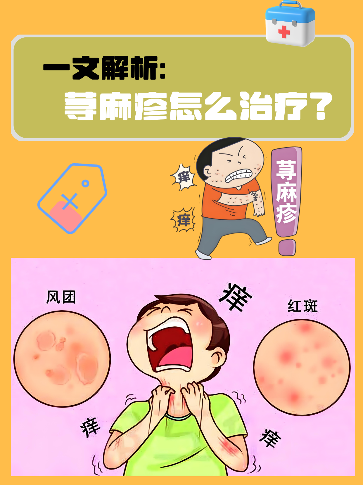 急性荨麻疹怎样止痒