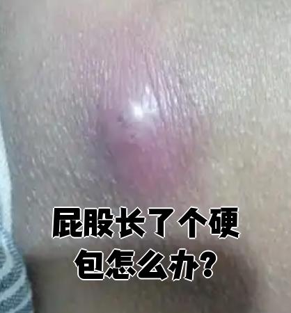 左臀部肉里面长了一个硬包好几年了,不痛不痒.