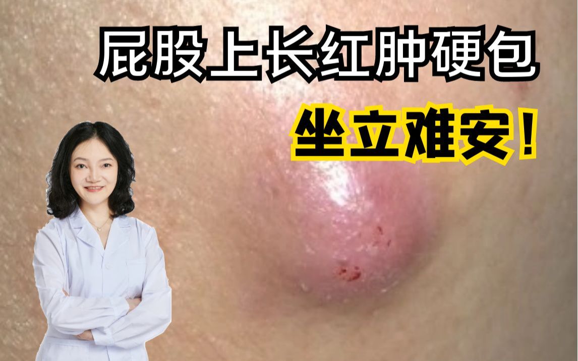 左臀部肉里面长了一个硬包好几年了,不痛不痒.