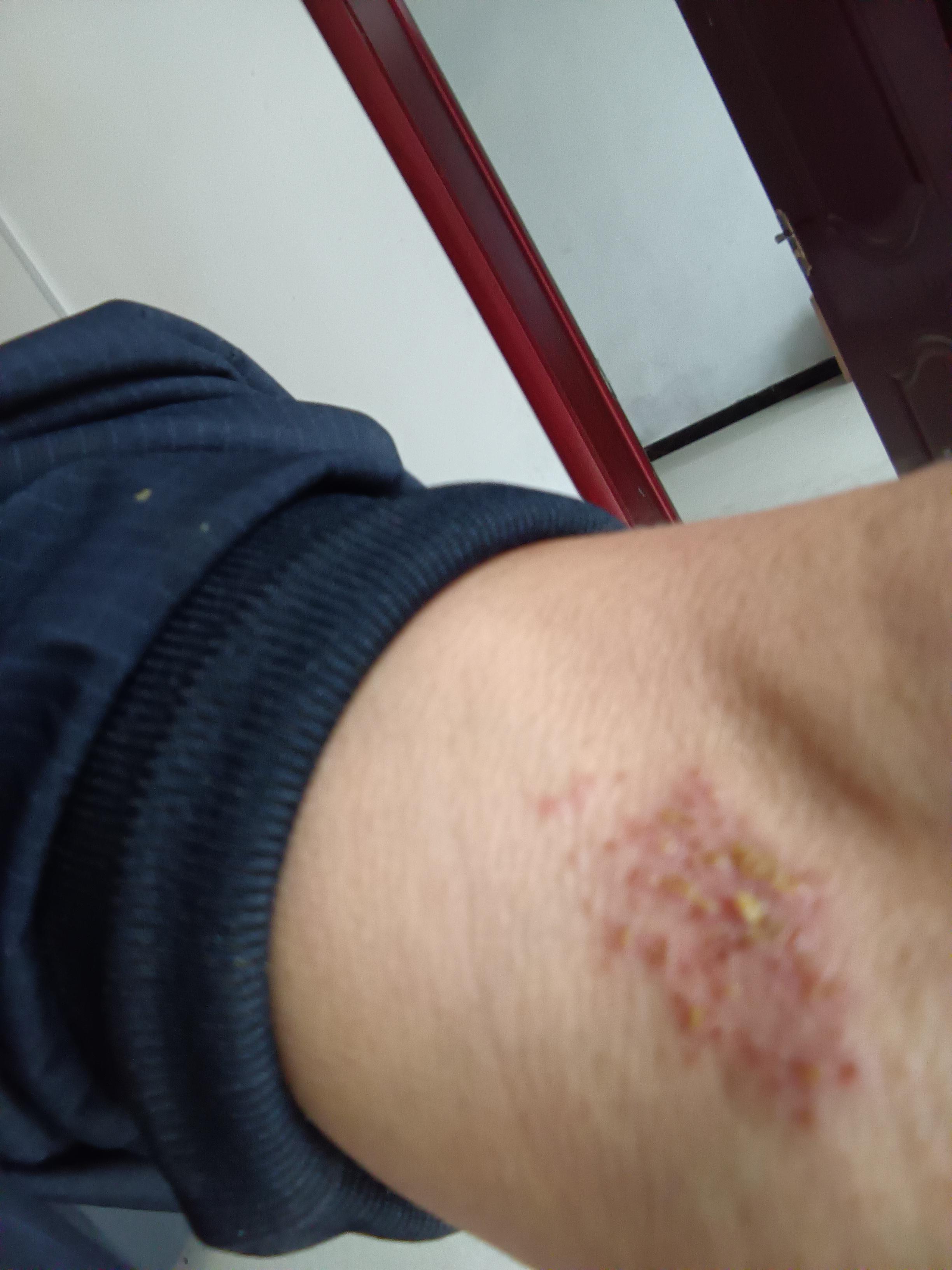 胳膊上起小红点