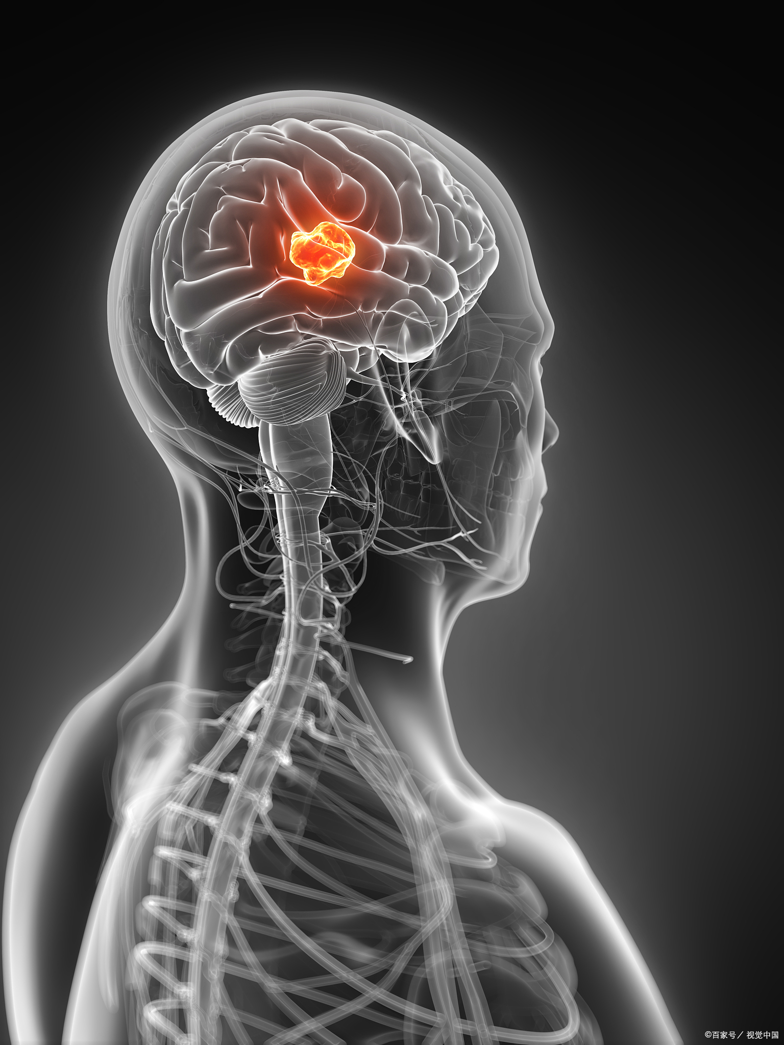 脑瘤的症状有几种
