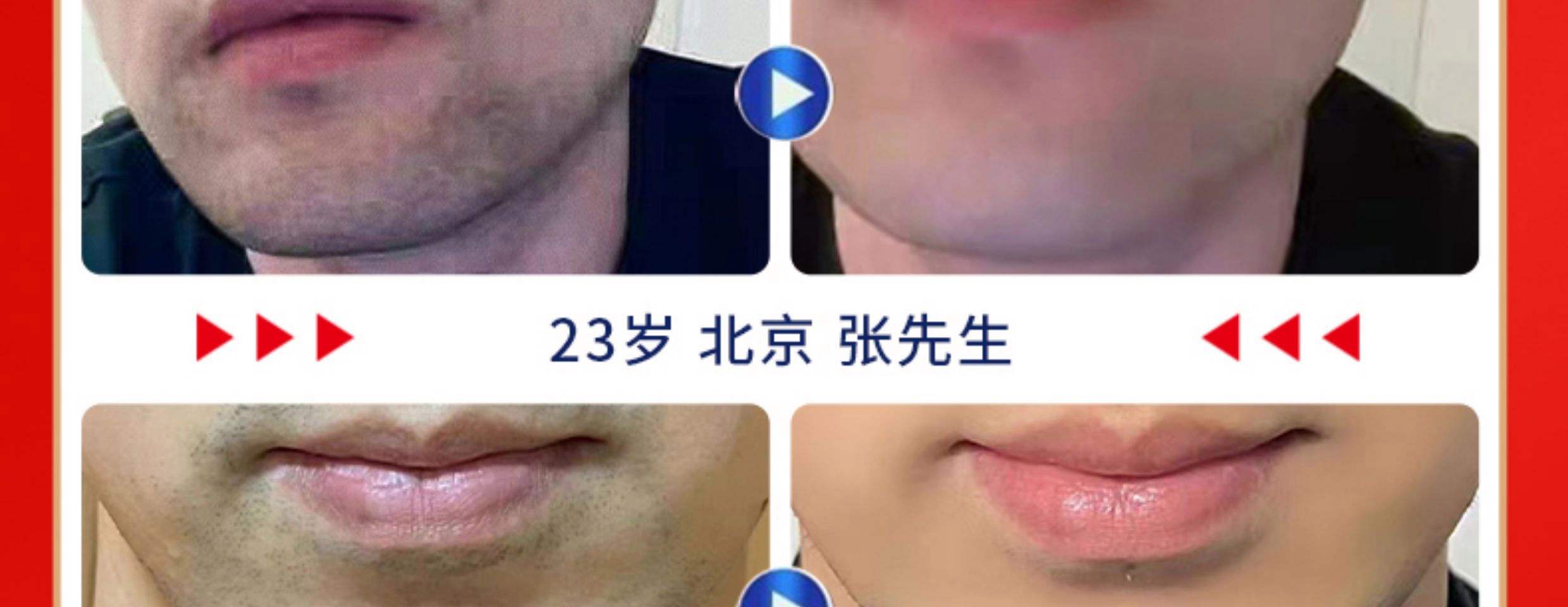 脸上长胡子怎么办?