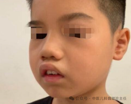 儿童鼻窦炎症状是什么?
