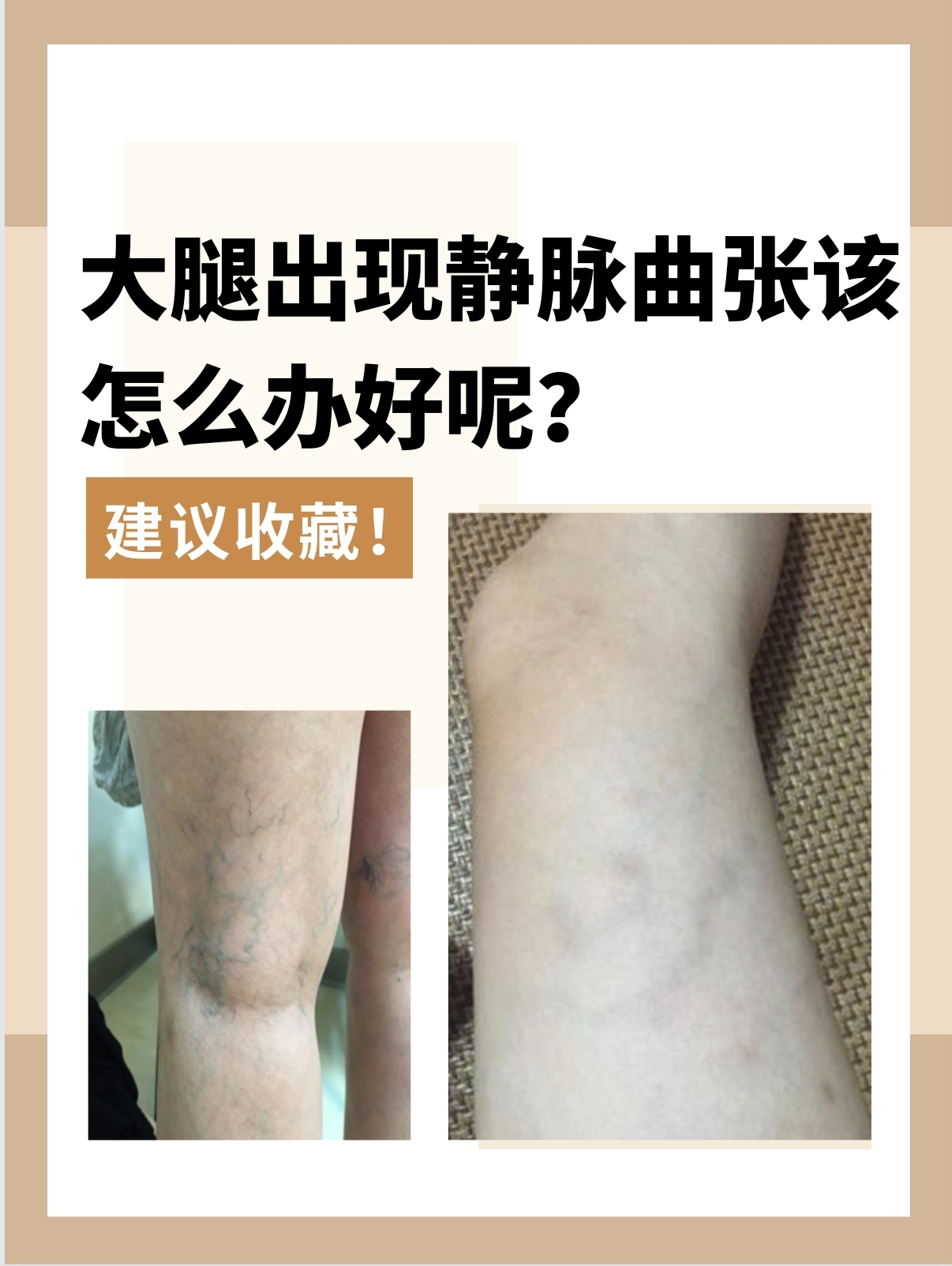 腿上的血管特别明显是怎么回事