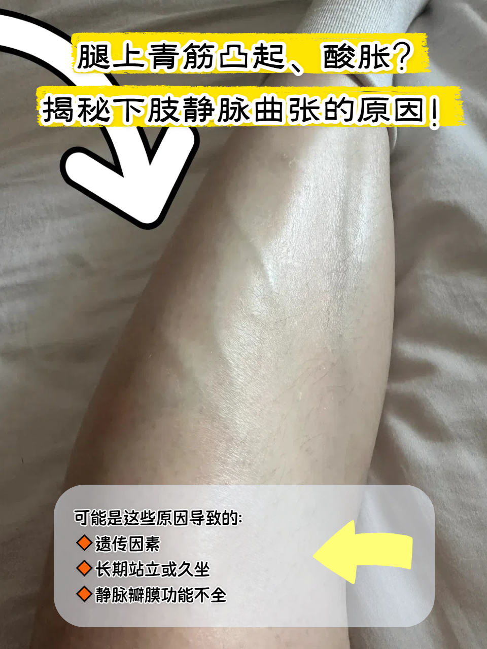 腿上的血管特别明显是怎么回事
