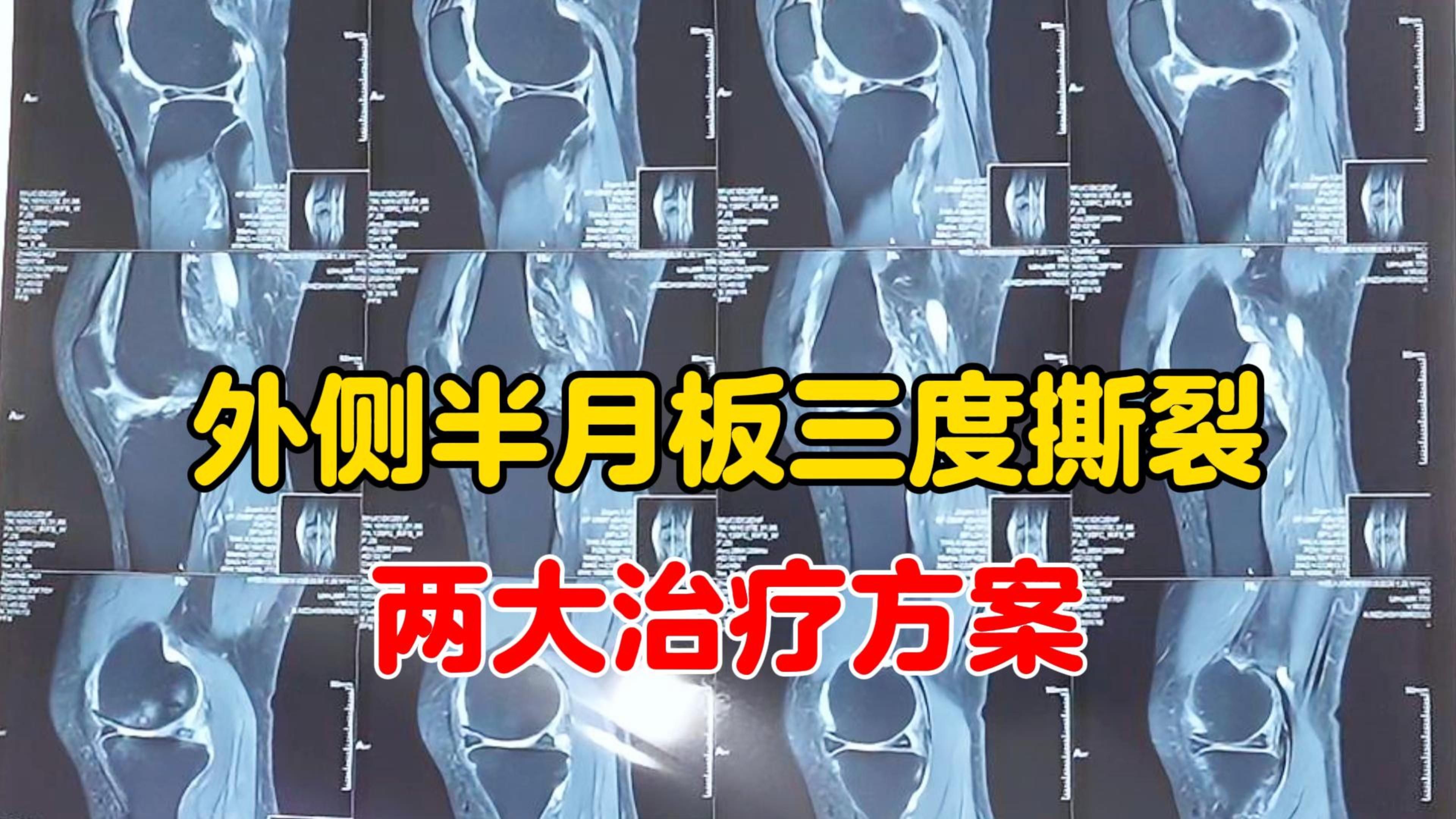 半月板损伤3度能自愈吗