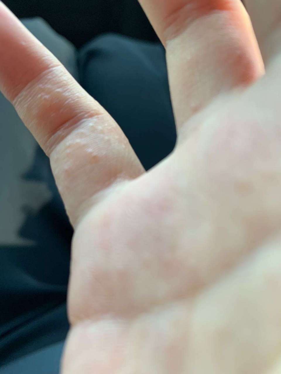 手上起小水泡