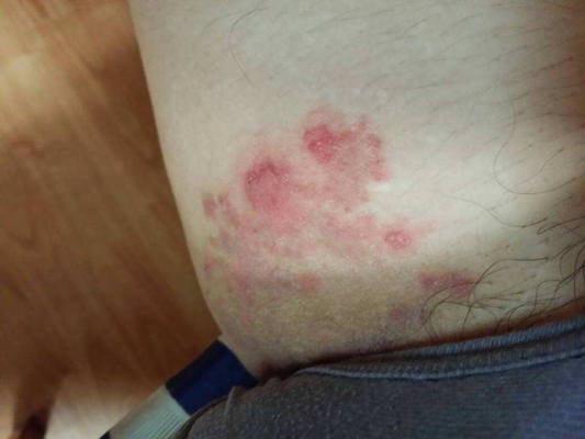 女人得性病的症状表现