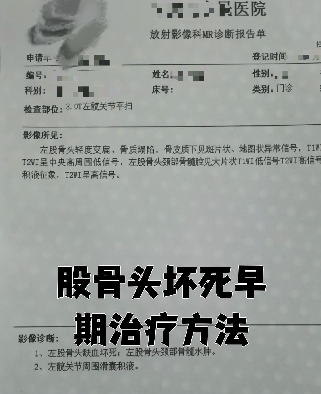 股骨头坏死治疗费用大约多少钱?