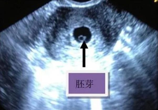 卵黄囊多久后有胎芽
