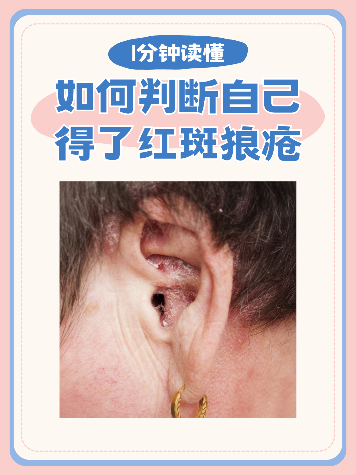 红斑狼疮的病因