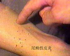 吸血虫病有什么症状