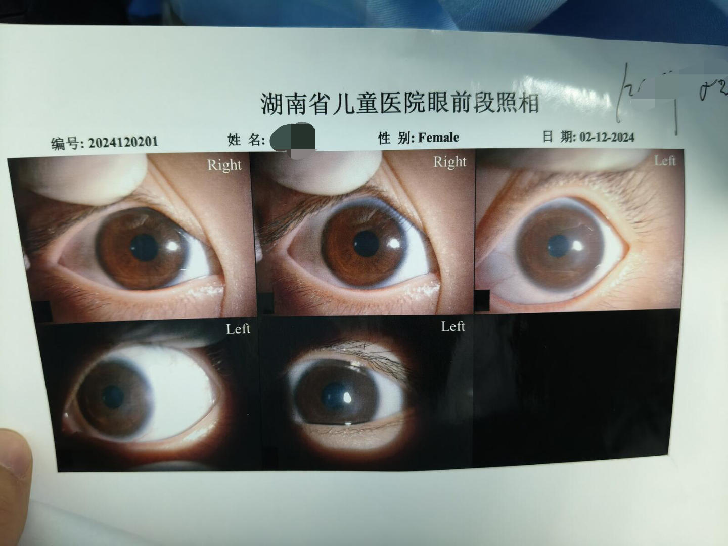 先天性角膜白斑