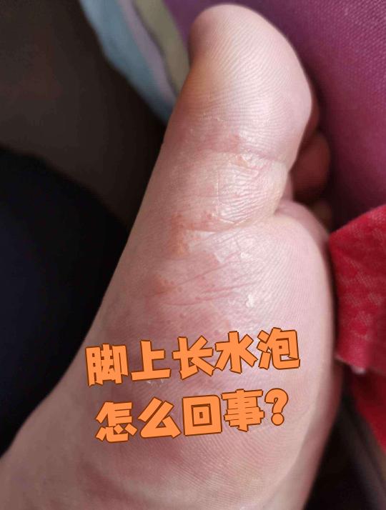 脚上起水泡痒怎么治