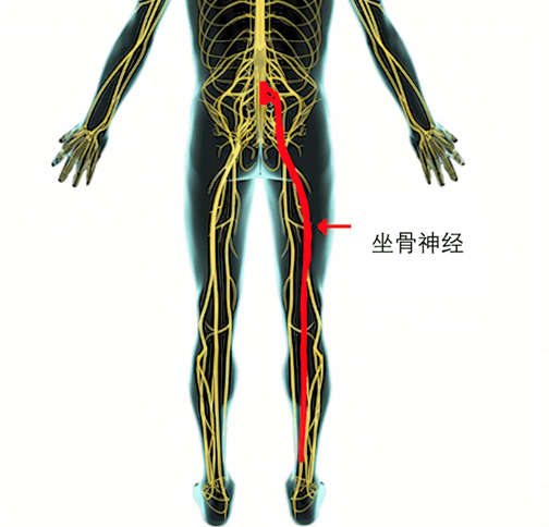 腰间盘突出压迫坐骨神经症状