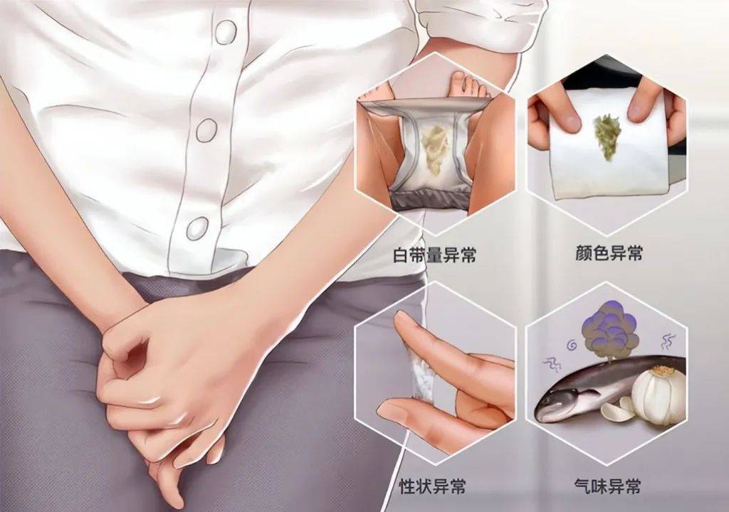 霉菌性阴炎的症状?