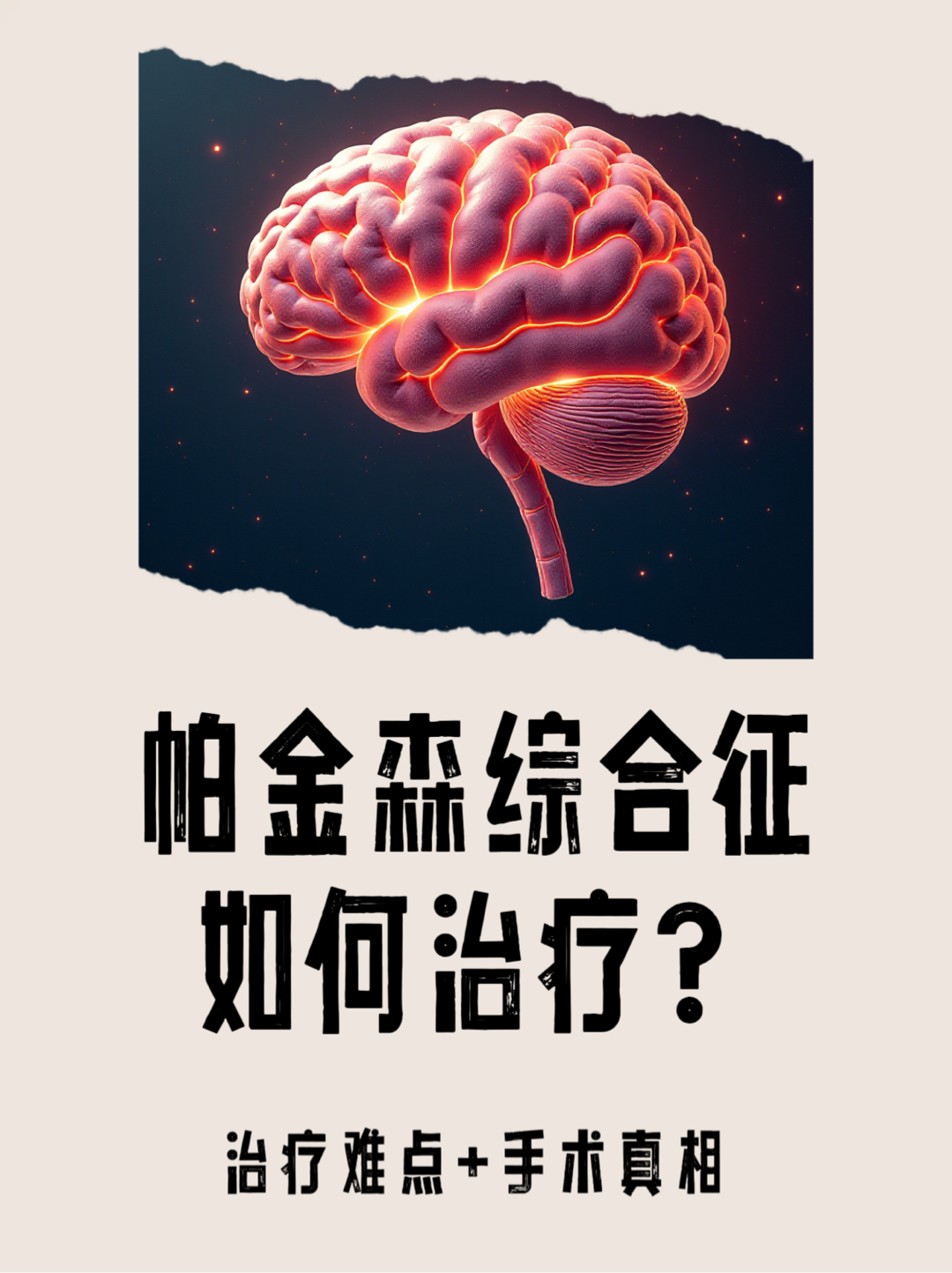 帕金森综合征早期症状有哪些