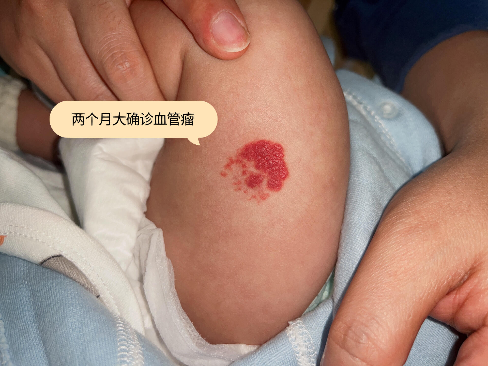 血管瘤能自己消退吗?