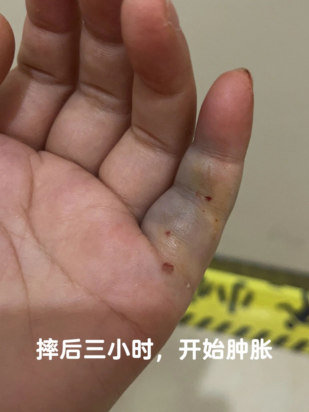 手指骨折的症状