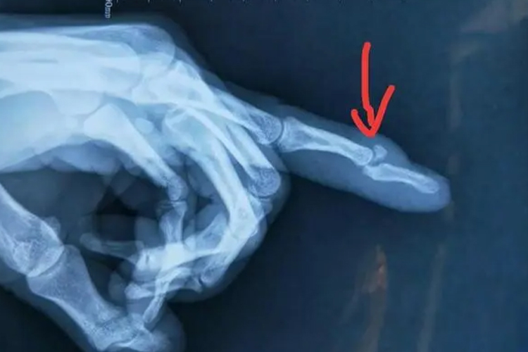 手指骨折的症状