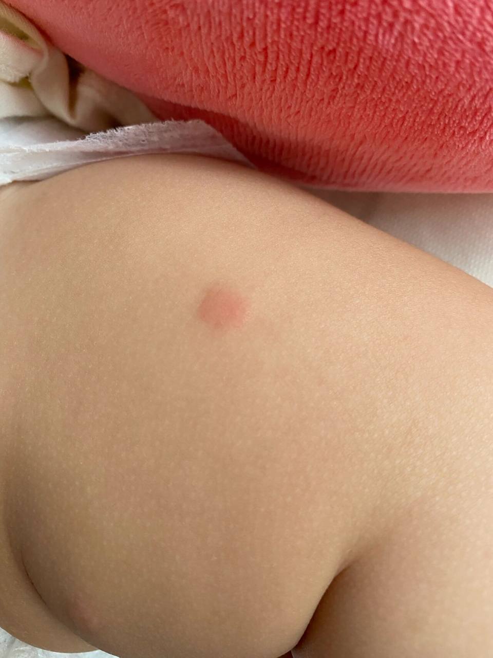 被蚊子咬后起很大一个疙瘩