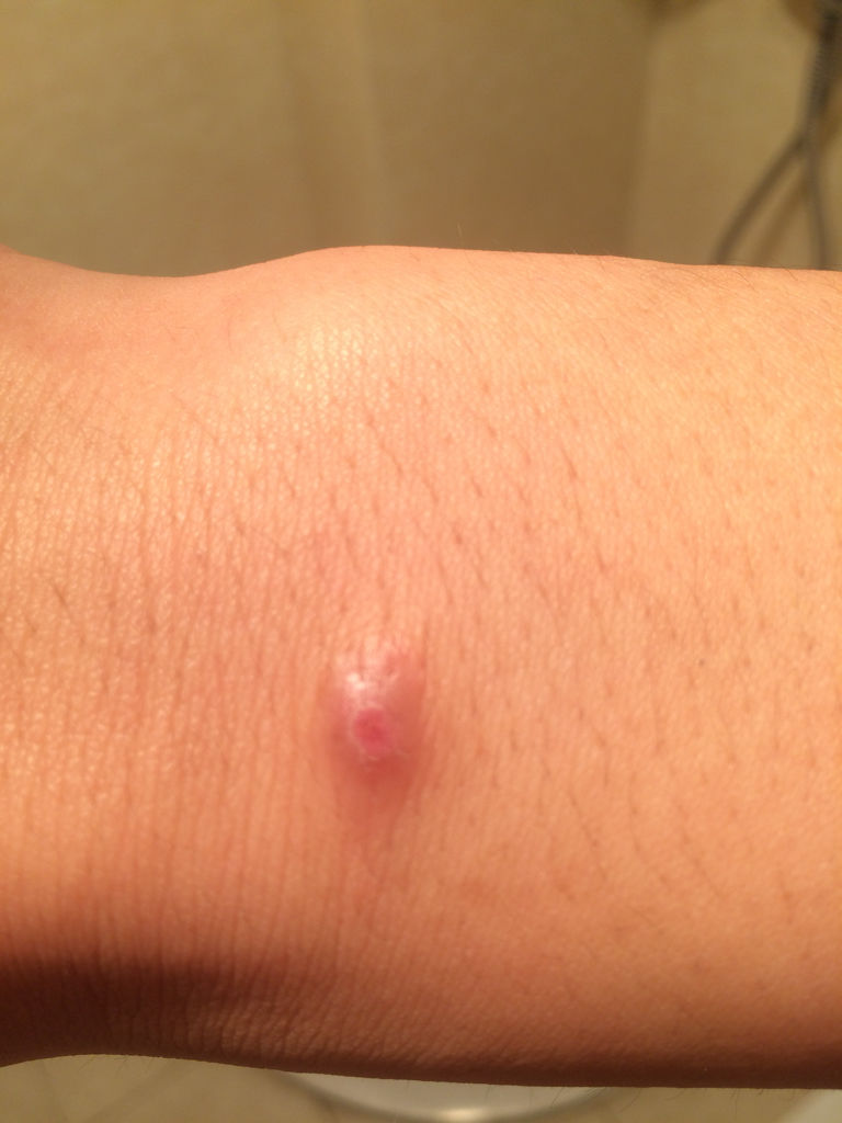 被蚊子咬后起很大一个疙瘩