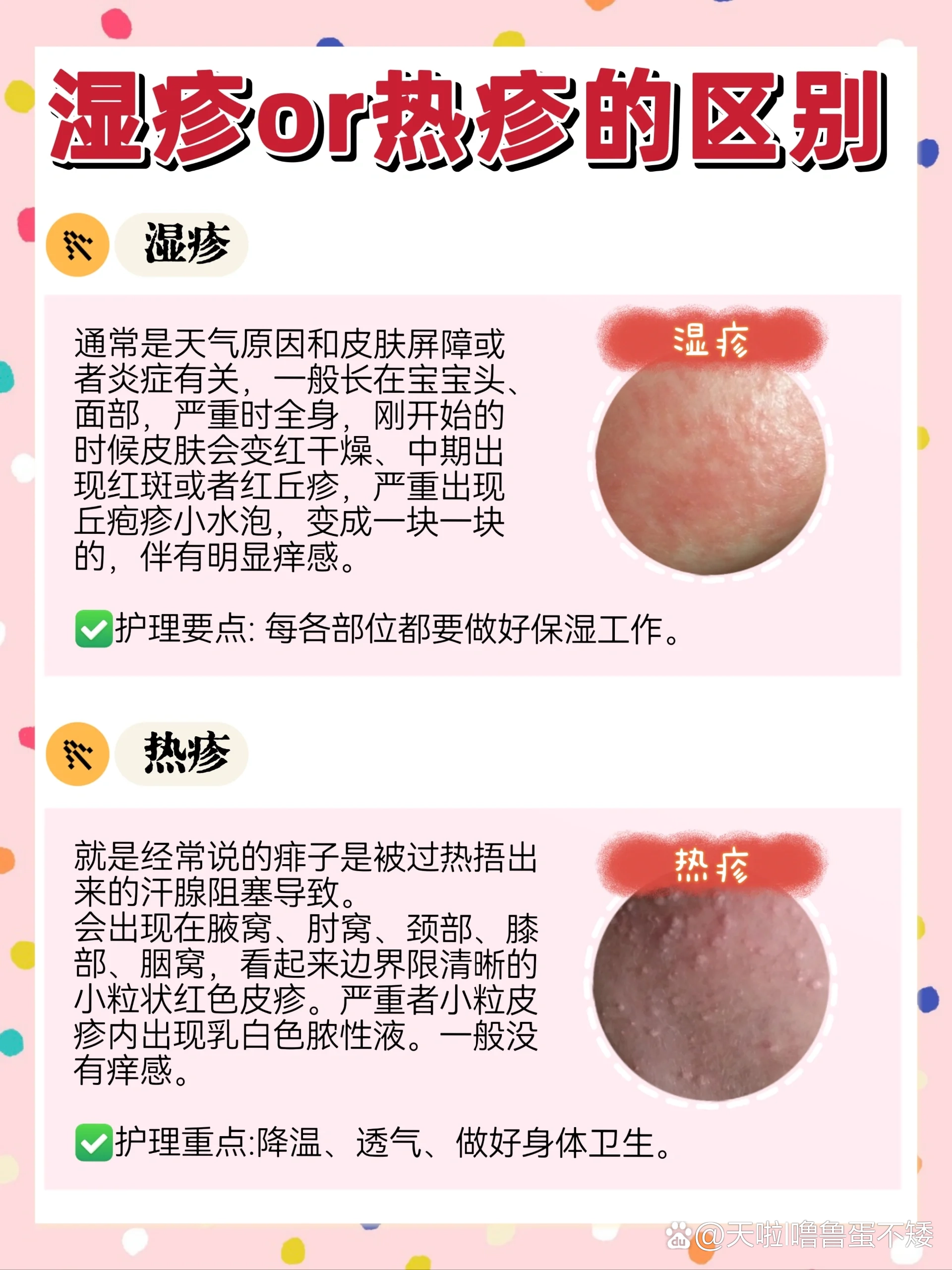 疱疹和湿疹的区别有哪些