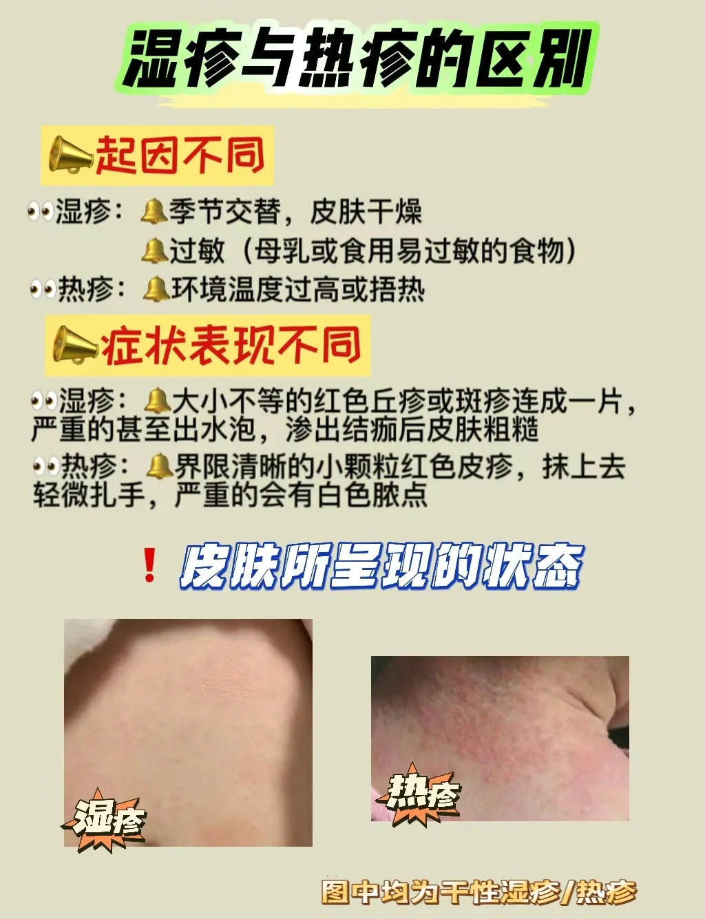 疱疹和湿疹的区别有哪些