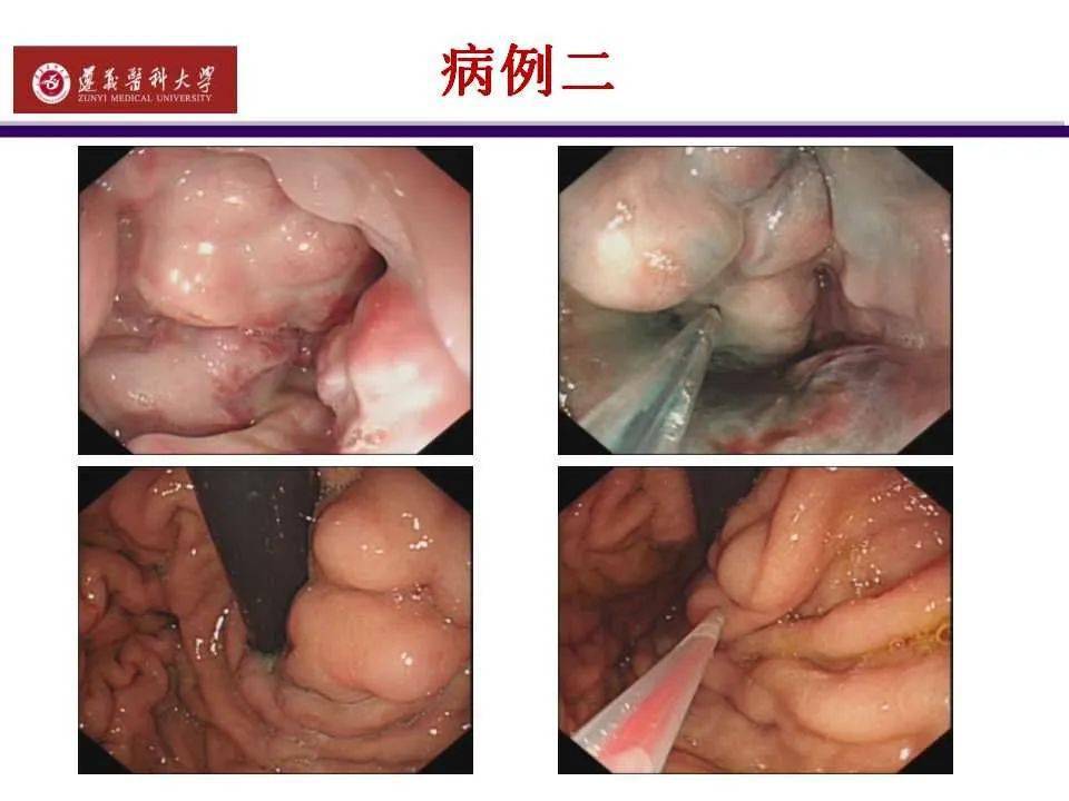 食管静脉曲张严重吗?