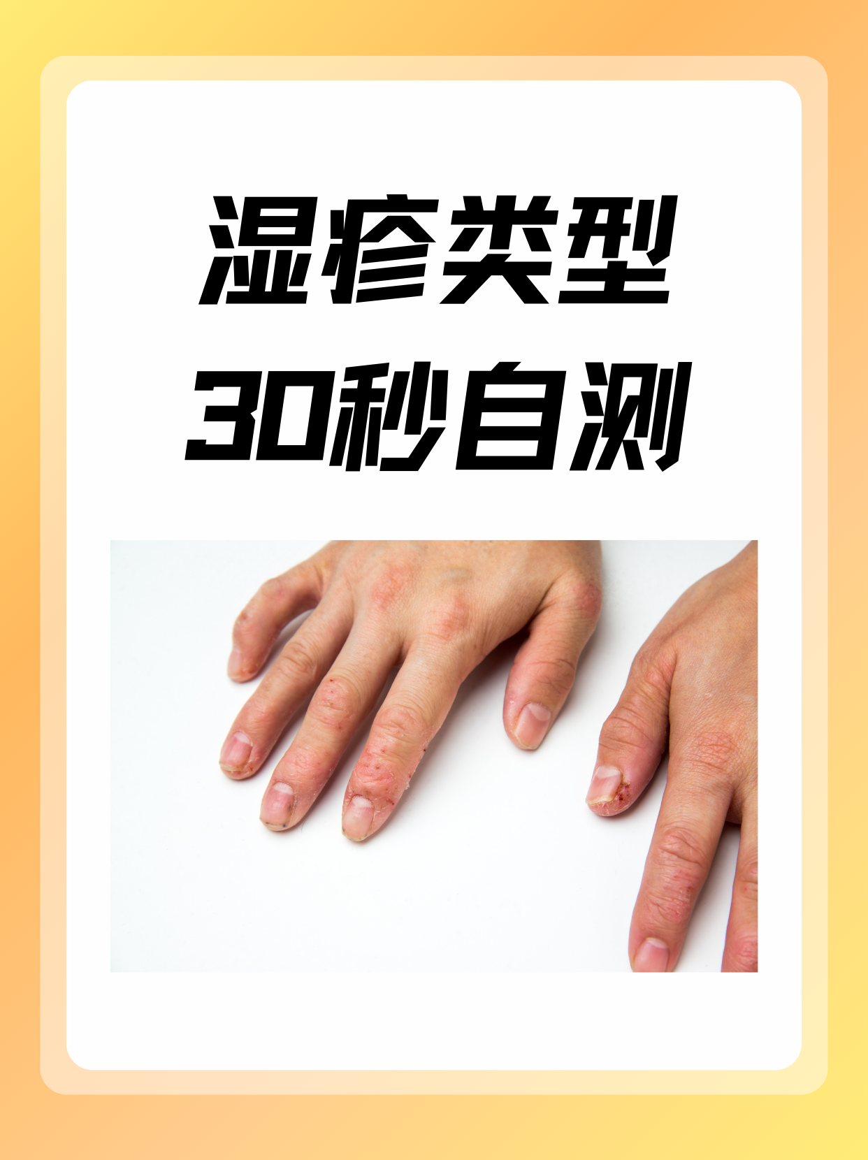 湿疹的症状特征