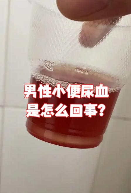尿是血红色的,但是不痛,是什么原因