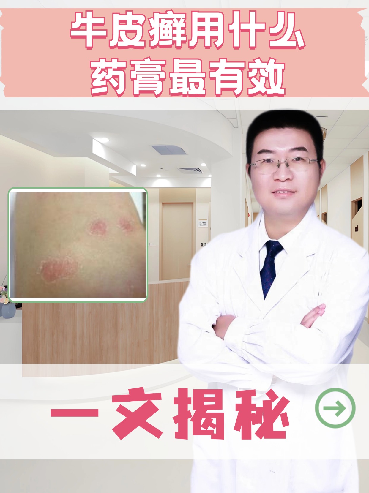银屑病怎么治疗最快
